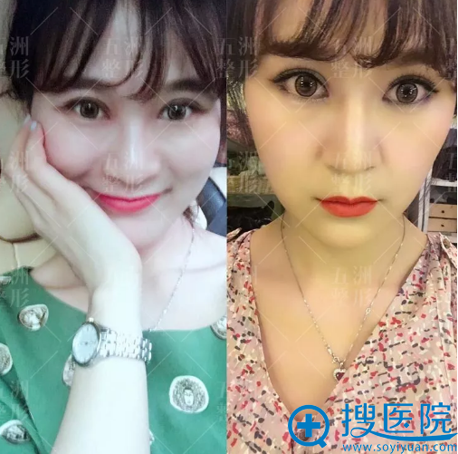 切开双眼皮术后20天恢复照片 切开双眼皮术后20天恢复照片