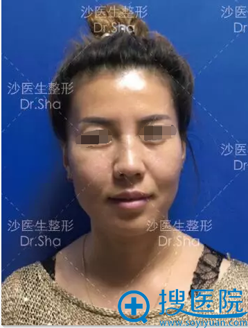 大连沙医生线性提拉和自体脂肪填充联合治疗真人案例