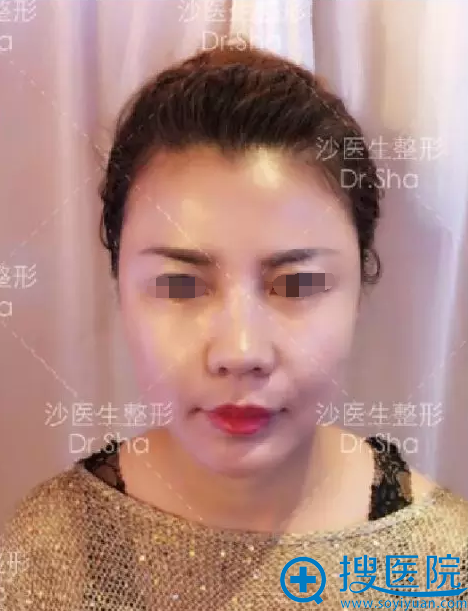 大连沙医生线性提拉和自体脂肪填充联合治疗即刻效果 大连沙医生线性提拉和自体脂肪填充联合治疗即刻效果