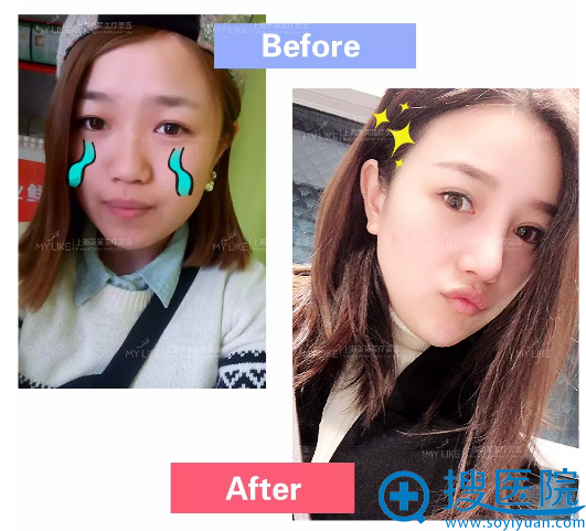 塌鼻子又爱玩抖音的姐姐找上海美莱整形医院卢建做了鼻综合隆鼻