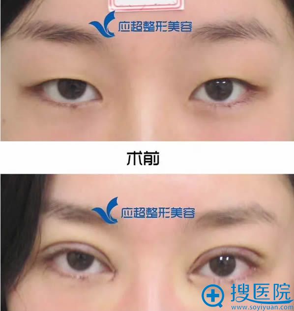 全切双眼皮和开眼角术后即刻效果 全切双眼皮和开眼角术后即刻效果