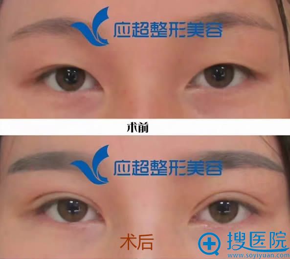 全切双眼皮一周后拆线的照片 全切双眼皮一周后拆线的照片