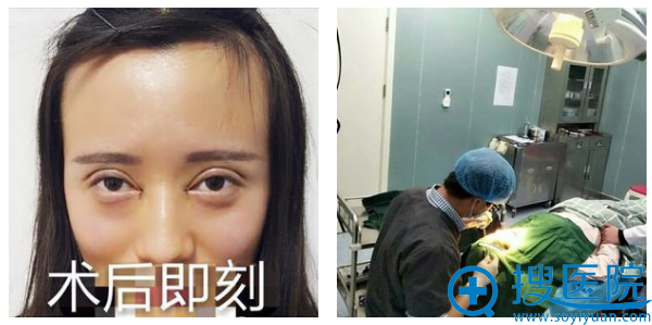 双眼皮术后即刻效果 双眼皮术后即刻效果
