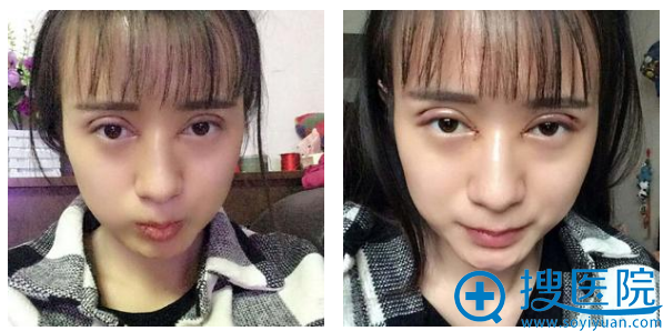 双眼皮术后第7天 双眼皮术后第7天