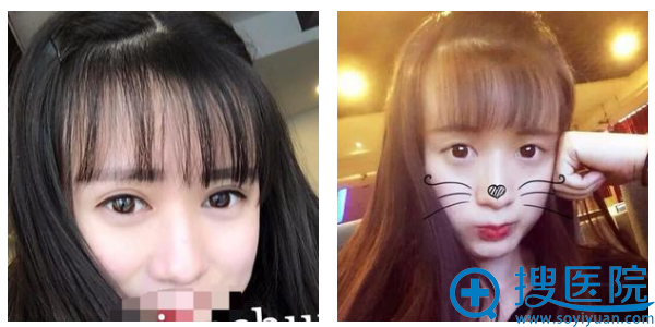 双眼皮术后三个月恢复情况 双眼皮术后三个月恢复情况