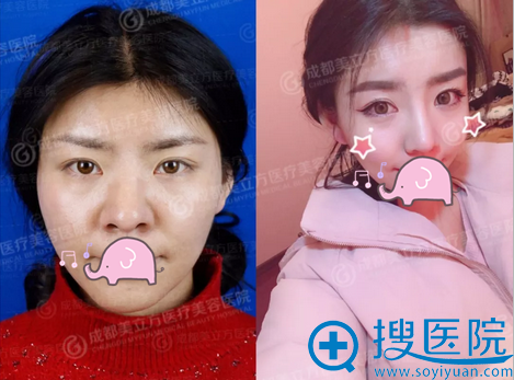 耳软骨鼻综合术前术后对比 耳软骨鼻综合术前术后对比