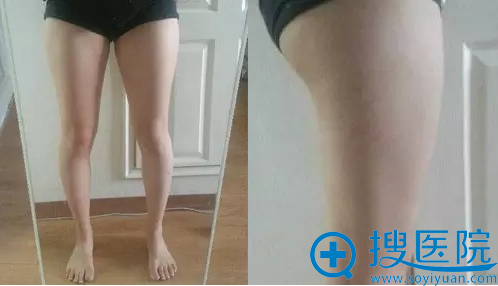 鼓起勇气在大同清木做了大腿吸脂 半年后的我又瘦又美