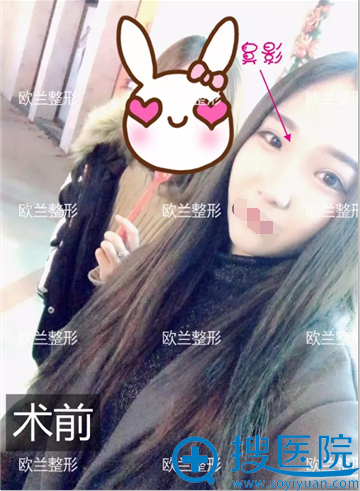 郑州欧兰李功哲肋软骨鼻综合案例 翘鼻仙女的恢复全记录