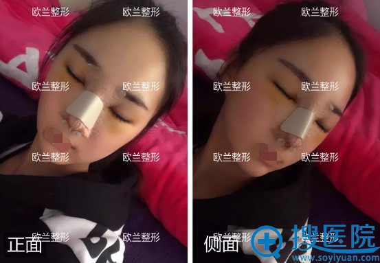 李功哲肋软骨鼻综合术后即刻 李功哲肋软骨鼻综合术后即刻