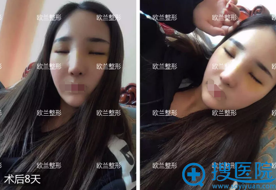 鼻综合拆了夹板后效果 鼻综合拆了夹板后效果
