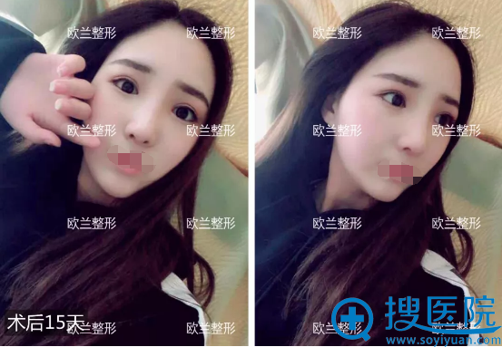 <!--<i data=20240710 data-id=12280></i>-->肋软骨鼻综合术后半个月 <!--<i data=20240710 data-id=12280></i>-->肋软骨鼻综合术后半个月