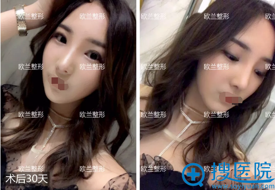 李功哲鼻综合术后化妆效果 李功哲鼻综合术后化妆效果