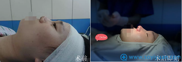 膨体鼻综合术前术后对比 膨体鼻综合术前术后对比