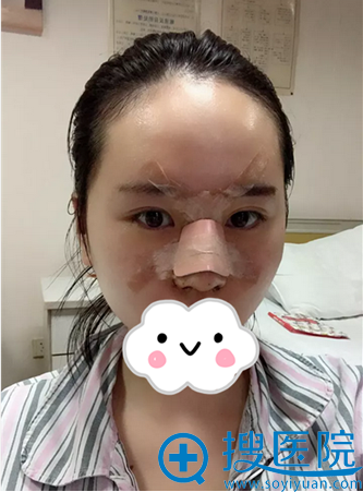 仝润泽膨体鼻综合术后4天恢复情况 仝润泽膨体鼻综合术后4天恢复情况