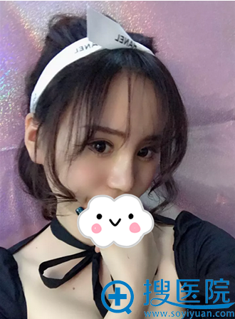 <!--<i data=20240710 data-id=14212></i>-->仝润泽隆鼻拆线后效果 <!--<i data=20240710 data-id=14212></i>-->仝润泽隆鼻拆线后效果