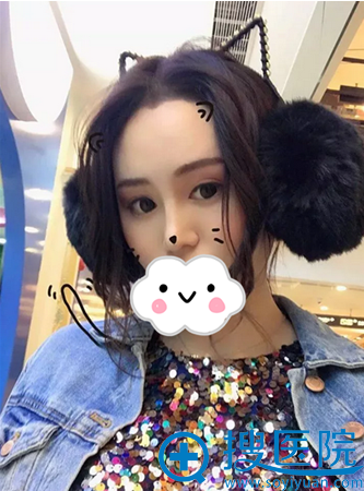 仝院长膨体综合术后效果 仝院长膨体综合术后效果