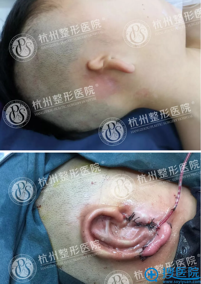 杭州整形耳再造效果对比 杭州整形耳再造效果对比