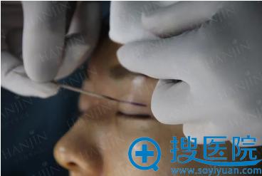 手术钱画线保障手术效果 手术钱画线保障手术效果