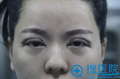昆明韩辰双眼皮+开眼角术后即可 昆明韩辰双眼皮+开眼角术后即可