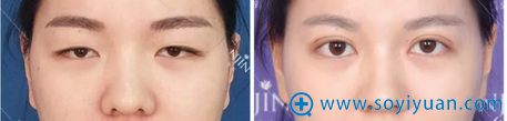 双眼皮+开眼角术前术后对比照片 双眼皮+开眼角术前术后对比照片