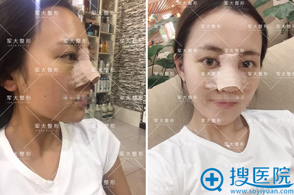 肋软骨鼻综合术后5天恢复照 肋软骨鼻综合术后5天恢复照