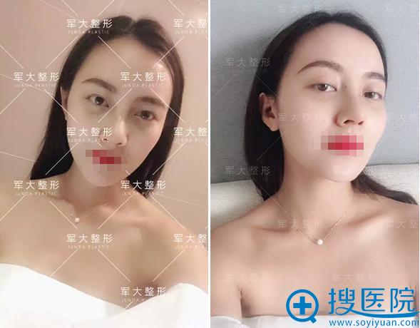 <!--<i data=20240710 data-id=15150></i>-->整形肋软骨鼻综合术后10天 <!--<i data=20240710 data-id=15150></i>-->整形肋软骨鼻综合术后10天