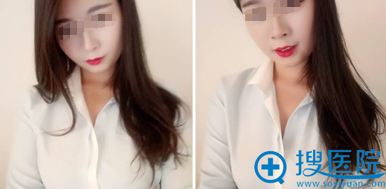 自体脂肪丰胸才半个月,我就恢复的不错了 自体脂肪丰胸才半个月,我就恢复的不错了
