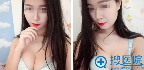 吕婧自体脂肪丰胸术后50天恢复效果 吕婧自体脂肪丰胸术后50天恢复效果