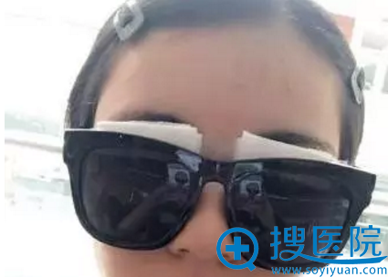 做双眼皮手术可以准备一副魔镜遮丑 做双眼皮手术可以准备一副魔镜遮丑