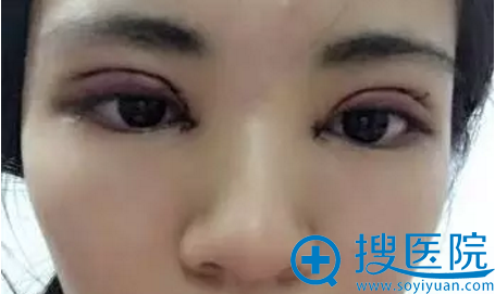 双眼皮手术纱布拆除后效果 双眼皮手术纱布拆除后效果