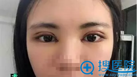 扬州美贝尔双眼皮术后4天照片 扬州美贝尔双眼皮术后4天照片