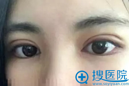双眼皮手术拆线效果 双眼皮手术拆线效果