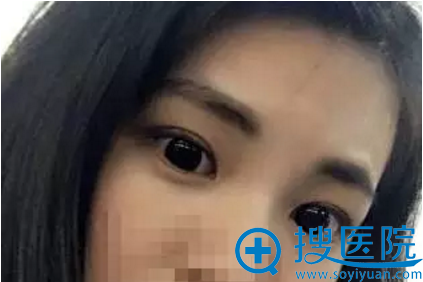双眼皮术后恢复化妆效果 双眼皮术后恢复化妆效果