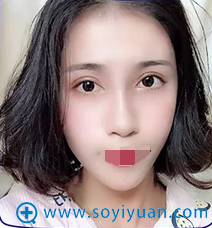 术后30天 好逼真啊 术后30天 好逼真啊