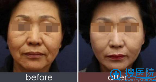 过年送妈妈礼物不防趁安徽韩美整形价格优惠,带她做面部除皱