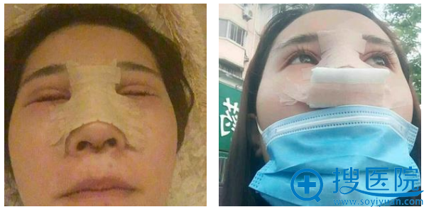 玻尿酸隆鼻失败的我找上海华晋医疗孙建斌医生做了膨体隆鼻手术