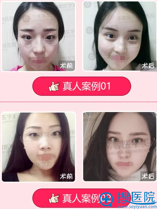 纳米脂肪混血脸对比 纳米脂肪混血脸对比