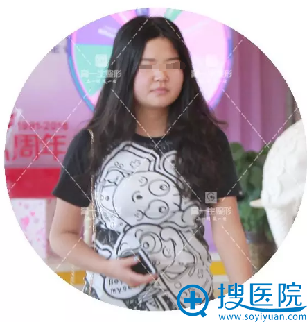 春节变胖在西安高一生通过下颌缘吸脂+腰腹吸脂找回S曲线