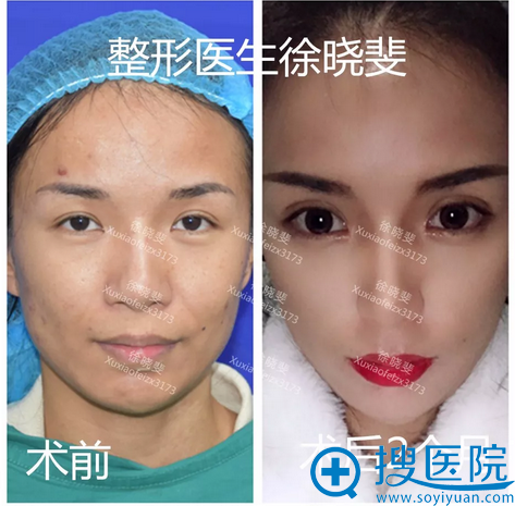 我这有一份上海伯思立(百达丽)徐晓斐做的双眼皮和隆鼻案例