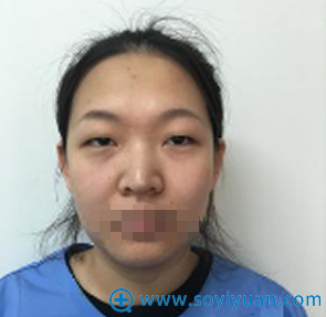 做开眼角双眼皮半年了 分享下青岛金岛徐建院长的术后效果