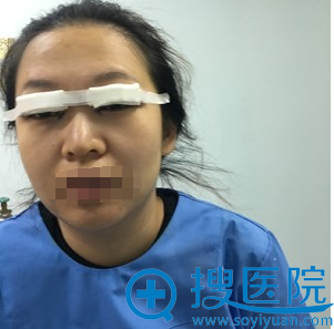 <!--<i data=20240710 data-id=11460></i>-->徐健双眼皮术后即刻照片 <!--<i data=20240710 data-id=11460></i>-->徐健双眼皮术后即刻照片