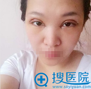徐健双眼皮拆线后效果图 徐健双眼皮拆线后效果图