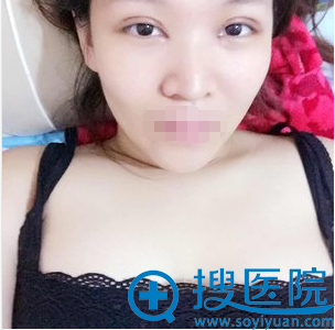 徐健双眼皮开眼角术后13天恢复照片 徐健双眼皮开眼角术后13天恢复照片