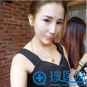青岛徐健双眼皮开眼角术后半年恢复效果 青岛徐健双眼皮开眼角术后半年恢复效果