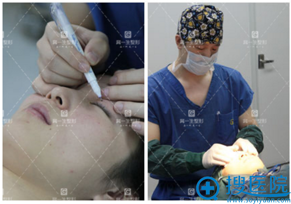西安高一生金磊院长双眼皮手术过程图 西安高一生金磊院长双眼皮手术过程图