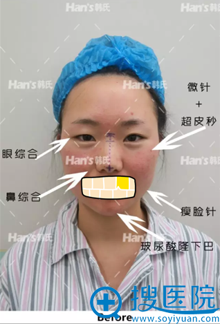 济南韩式眼鼻综合全面部打造真人案例对比照见证女神的诞生