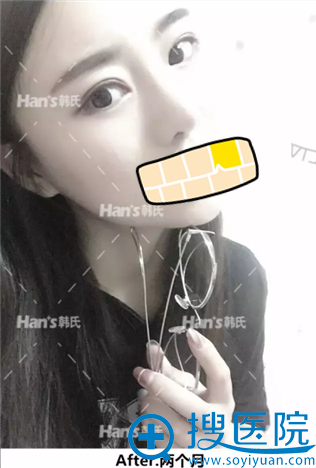 济南韩式眼综合+鼻综合术后2个月恢复效果 济南韩式眼综合+鼻综合术后2个月恢复效果