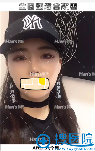 济南韩式+玻尿酸隆下巴5个月效果 济南韩式+玻尿酸隆下巴5个月效果
