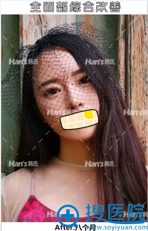 济南韩式微针+超皮秒术后8个月照片 济南韩式微针+超皮秒术后8个月照片