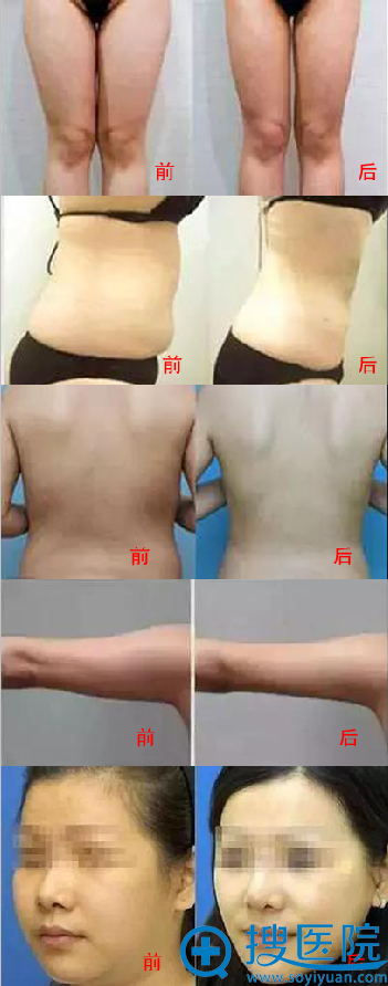 想拥有迷人S型身材 重庆时光激光溶脂真的既能瘦身又不反弹?
